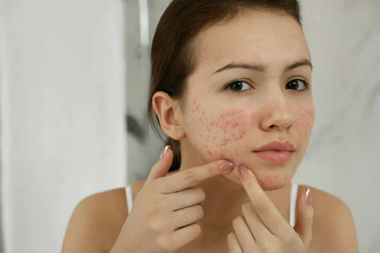 6 Different Types Of Acne Scars And How To Treat Them