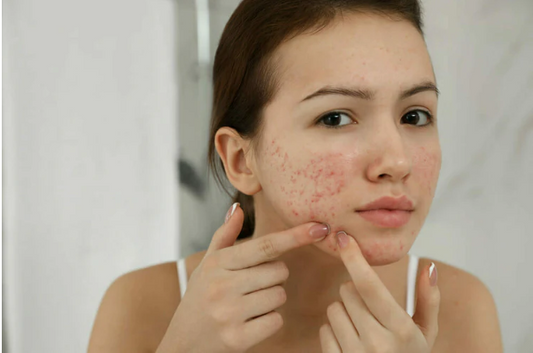 What Would You Accomplish if You Didn’t Have Acne Scars?