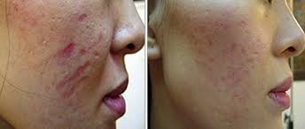 acne-scars-removal